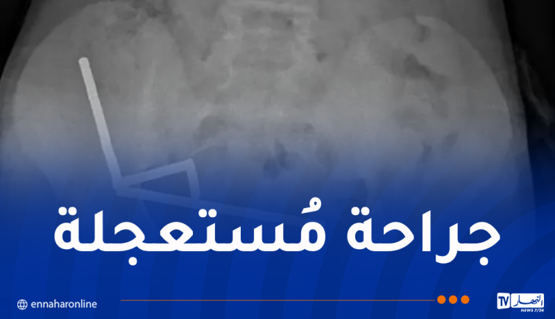 صبي يبتلع 100 مغناطيس!!