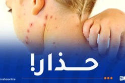 تسجيل حالات “الجرب” في المدارس.. وزارة الصحة تكشف الحقيقة!