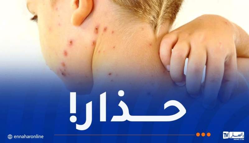 تسجيل حالات “الجرب” في المدارس.. وزارة الصحة تكشف الحقيقة!