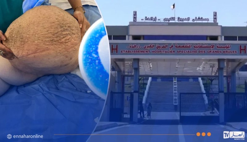 إنجاز طبي نادر بمستشفى الحروق الكبری الدكتور سعيد شيبان – زرالدة