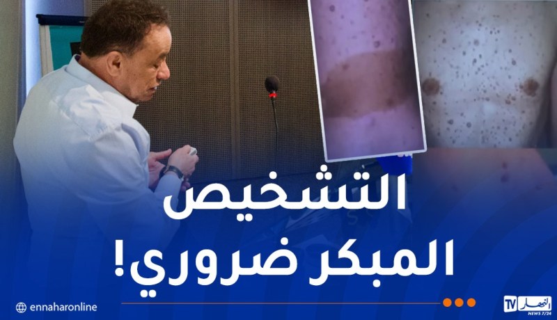 أطباء يحذّرون.. هذه أعراض الورم الليفي العصبي من النوع الأول (NF1)